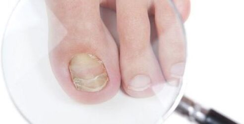 A gomba diagnosztizálása