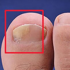 Mycosis vagy körömgomba