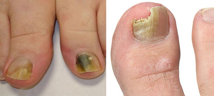 Onychomycosis - körmök megsemmisítése gomba segítségével