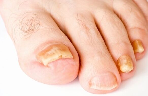 Az onychomycosis disztrófiás (előrehaladott) stádiuma